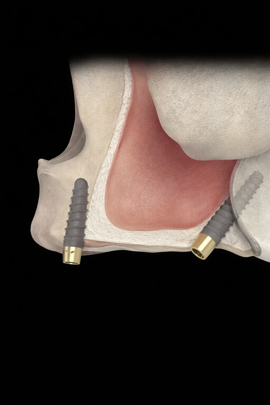 NASAL VE PTERYGOİD İMPLANTLAR